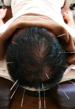脱毛症・育毛の鍼